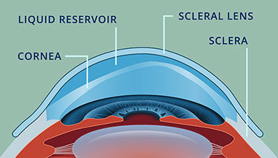 Quando sono indicate le lenti sclerali?