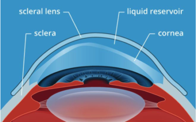 Scopriamo le lenti a contatto sclerali